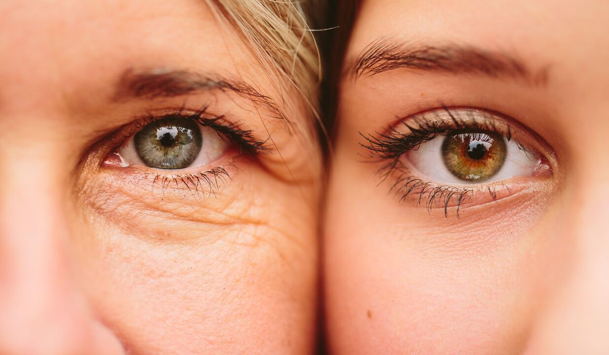 senėjimo požymiai aplink akis