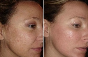 veido odos atjauninimas lazeriu prieš ir po nuotraukų